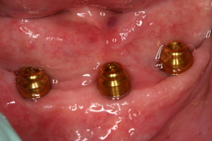 Implant Retained Denture