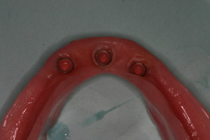 implant retained denture